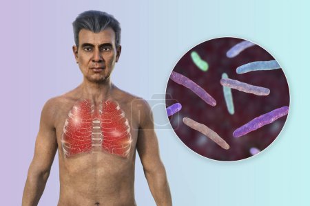 Foto de Una ilustración fotorrealista en 3D de la mitad superior de un hombre con piel transparente, mostrando los pulmones afectados por la tuberculosis miliar y una visión cercana de la bacteria Mycobacterium tuberculosis - Imagen libre de derechos