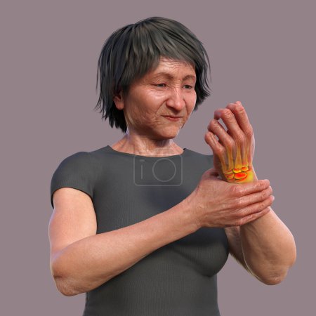 Foto de Una mujer que experimenta dolor en la muñeca, con el esqueleto resaltado para mostrar el área afectada, ilustración 3D - Imagen libre de derechos