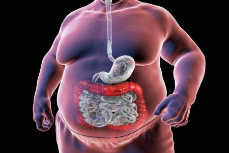 A 3D medical illustration depicting the upper half part of a senior obese male body, highlighting the digestive system, aimed at illustrating digestive disorders associated with obesity.