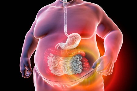 A 3D medical illustration depicting the upper half part of a senior obese male body with a highlighted digestive system, specifically showcasing large bowel spasms observed in irritable bowel syndrome