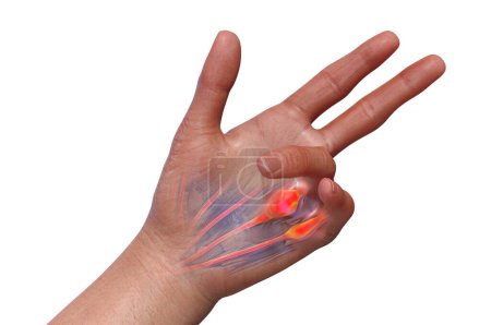 Eine medizinische 3D-Illustration, die die Hand eines Patienten mit Dupuytrens Kontraktion zeigt, wobei die betroffenen Sehnen und die Palmarfaszien hervorgehoben werden, um die grobe Pathologie der Erkrankung zu veranschaulichen.