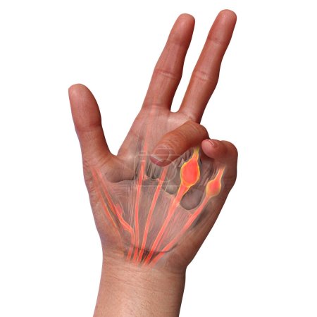 Una ilustración médica en 3D que muestra la mano de un paciente con la contractura de Dupuytren, enfatizando los tendones afectados y la fascia palmar para ilustrar la patología macroscópica de la afección.