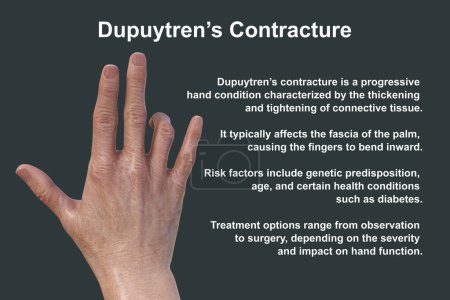 Foto de Mano de un paciente con contractura de Dupuytren, una condición que hace que los dedos se doblen hacia la palma, ilustración fotorrealista 3D - Imagen libre de derechos