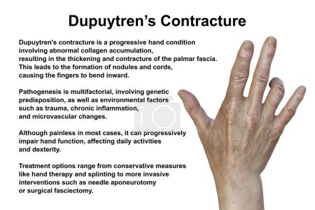 Foto de Mano de un paciente con contractura de Dupuytren, una condición que hace que los dedos se doblen hacia la palma, ilustración fotorrealista 3D - Imagen libre de derechos