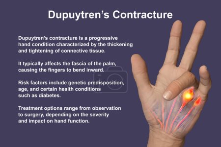 Foto de Una ilustración médica en 3D que muestra la mano de un paciente con la contractura de Dupuytren, enfatizando los tendones afectados y la fascia palmar para ilustrar la patología macroscópica de la afección. - Imagen libre de derechos