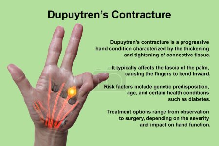 Photo for A 3D medical illustration displaying a patient's hand with Dupuytren's contracture, emphasizing the affected tendons and palmar fascia to illustrate the gross pathology of the condition. - Royalty Free Image