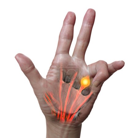 Téléchargez les photos : Illustration médicale 3D montrant la main d'un patient avec la contracture de Dupuytren, mettant l'accent sur les tendons affectés et le fascia palmaire pour illustrer la pathologie grossière de la maladie. - en image libre de droit