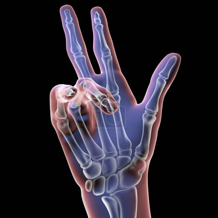 Foto de Mano de un paciente con contractura de Dupuytren, una condición que hace que los dedos se doblen hacia la palma de la mano, ilustración 3D - Imagen libre de derechos