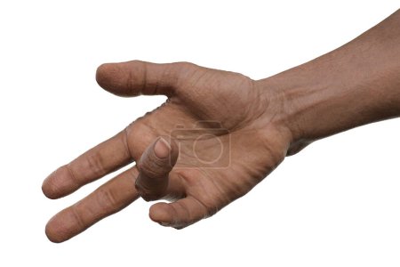 Foto de Mano de un paciente masculino con contractura de Dupuytren, una condición que hace que los dedos se doblen hacia la palma, ilustración fotorrealista 3D - Imagen libre de derechos