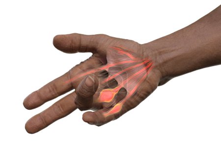 Foto de Una ilustración médica en 3D que muestra la mano de un paciente con la contractura de Dupuytren, enfatizando los tendones afectados y la fascia palmar para ilustrar la patología macroscópica de la afección. - Imagen libre de derechos