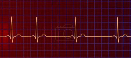 Eine detaillierte 3D-Illustration eines Elektrokardiogramm-EKGs zur Darstellung von Sinusrhythmusstörungen, einem Zustand, der durch unregelmäßige Herzrhythmen vom Sinusknoten ausgeht.