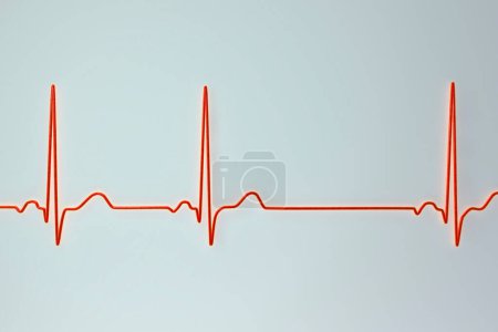 Foto de Una ilustración 3D detallada de un electrocardiograma ECG que muestra arritmia sinusal, una condición caracterizada por ritmos cardíacos irregulares que se originan en el nodo sinusal. - Imagen libre de derechos