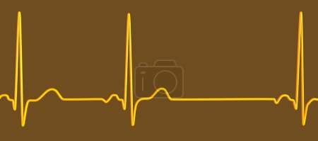 Photo for A detailed 3D illustration of an Electrocardiogram ECG displaying sinus arrhythmia, a condition characterized by irregular heart rhythms originating from the sinus node. - Royalty Free Image