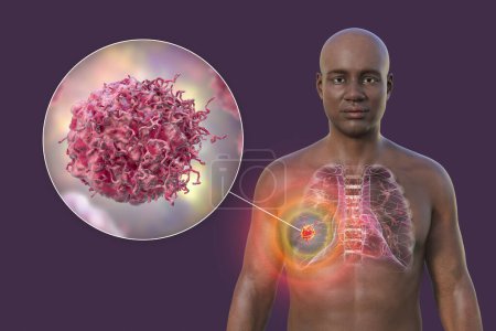 Téléchargez les photos : Illustration photoréaliste en 3D de la moitié supérieure d'un Africain à la peau transparente, révélant la présence d'un cancer du poumon, et vue rapprochée des cellules cancéreuses - en image libre de droit