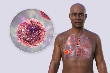 Photo for A 3D photorealistic illustration of the upper half part of an African man with transparent skin, revealing the presence of lung cancer, and close-up view of cancer cells - Royalty Free Image