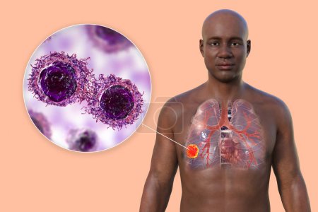 Foto de Una ilustración fotorrealista en 3D de la mitad superior de un hombre africano con piel transparente, que revela la presencia de cáncer de pulmón y una visión cercana de las células cancerosas - Imagen libre de derechos