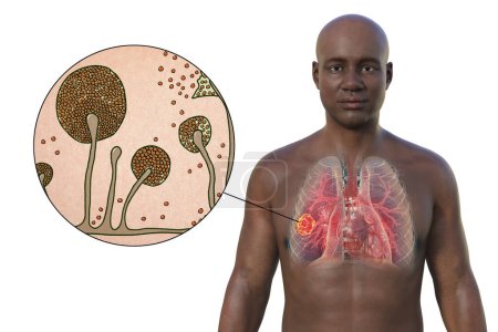 Téléchargez les photos : Illustration photoréaliste en 3D de la moitié supérieure d'un Africain à peau transparente, révélant une lésion de mucormycose pulmonaire, avec vue rapprochée des champignons Mucor - en image libre de droit
