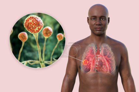 Photo for A 3D photorealistic illustration of the upper half part of an African man with transparent skin, revealing a lung mucormycosis lesion, with close-up view of Mucor fungi - Royalty Free Image