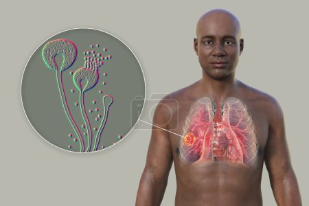Photo for A 3D photorealistic illustration of the upper half part of an African man with transparent skin, revealing a lung mucormycosis lesion, with close-up view of Mucor fungi - Royalty Free Image