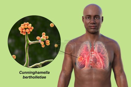 Photo for A 3D photorealistic illustration of the upper half part of an African man with transparent skin, revealing a lung mucormycosis lesion, with close-up view of Cunninghamella bertholletiae fungi - Royalty Free Image