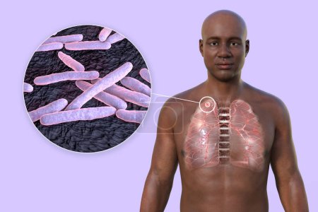 Foto de Una ilustración en 3D que muestra la mitad superior de un hombre africano con piel transparente, revelando los pulmones afectados por la tuberculosis secundaria y la vista de cerca de la bacteria Mycobacterium tuberculosis - Imagen libre de derechos