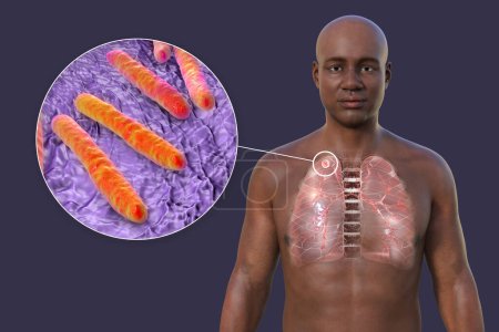 Foto de Una ilustración en 3D que muestra la mitad superior de un hombre africano con piel transparente, revelando los pulmones afectados por la tuberculosis secundaria y la vista de cerca de la bacteria Mycobacterium tuberculosis - Imagen libre de derechos