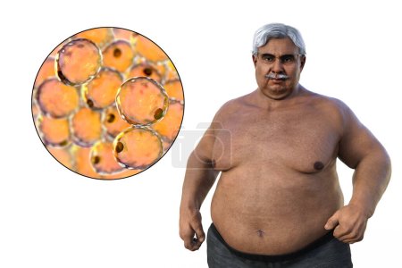 Foto de Una ilustración médica en 3D que representa a un hombre mayor con sobrepeso con una visión cercana de los adipocitos, destacando el papel de estas células grasas en la obesidad. - Imagen libre de derechos