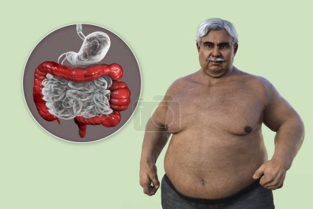 Photo for A senior overweight man, and close-up view of his digestive system highlighting the presence of large intestine spasms associated with irritable bowel syndrome, 3D illustration. - Royalty Free Image