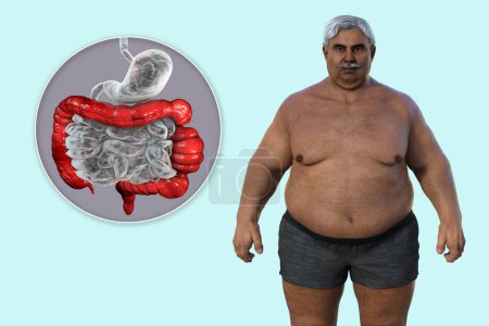 Photo for A senior overweight man, and close-up view of his digestive system highlighting the presence of large intestine spasms associated with irritable bowel syndrome, 3D illustration. - Royalty Free Image