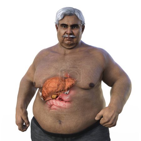 Foto de Una ilustración médica en 3D con un hombre mayor con sobrepeso y piel transparente, mostrando el hígado y destacando la presencia de esteatosis hepática. - Imagen libre de derechos
