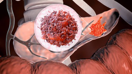 Foto de Cáncer de páncreas, tumor maligno del páncreas con vista de cerca de las células cancerosas, ilustración 3D - Imagen libre de derechos