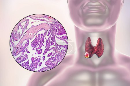 Foto de Una ilustración científica en 3D que muestra un cuerpo humano con piel transparente, revelando un tumor en su glándula tiroides, junto con una imagen micrográfica del carcinoma papilar de tiroides. - Imagen libre de derechos