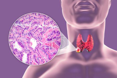 Photo for A 3D scientific illustration showcasing a human body with transparent skin, revealing a tumor in his thyroid gland, along with a micrograph image of papillary thyroid carcinoma. - Royalty Free Image