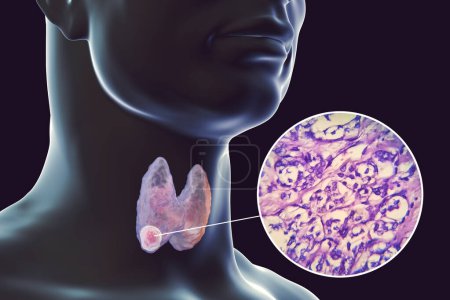 Téléchargez les photos : Illustration scientifique 3D montrant un corps humain à la peau transparente, révélant une tumeur dans sa glande thyroïde, ainsi qu'une image micrographique du carcinome folliculaire thyroïdien. - en image libre de droit