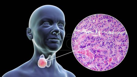 Foto de Una ilustración científica en 3D que muestra un cuerpo femenino con piel transparente, revelando un tumor en la glándula tiroides, junto con una imagen micrográfica del carcinoma papilar de tiroides. - Imagen libre de derechos
