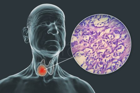 Foto de Una ilustración científica en 3D que muestra un cuerpo humano con piel transparente, revelando un tumor en su glándula tiroides, junto con una imagen micrográfica del carcinoma folicular tiroideo. - Imagen libre de derechos