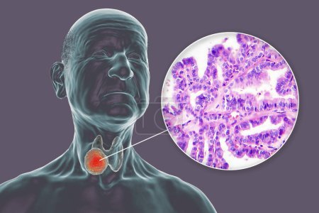 Téléchargez les photos : Illustration scientifique 3D montrant un corps humain à la peau transparente, révélant une tumeur dans sa glande thyroïde, ainsi qu'une image micrographique du carcinome thyroïdien papillaire. - en image libre de droit