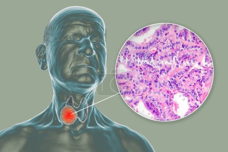 Foto de Una ilustración científica en 3D que muestra un cuerpo humano con piel transparente, revelando un tumor en su glándula tiroides, junto con una imagen micrográfica del carcinoma papilar de tiroides. - Imagen libre de derechos