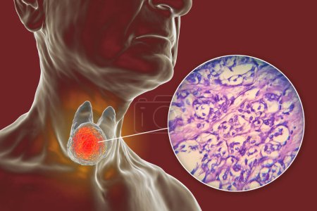 Foto de Una ilustración científica en 3D que muestra un cuerpo humano con piel transparente, revelando un tumor en su glándula tiroides, junto con una imagen micrográfica del carcinoma folicular tiroideo. - Imagen libre de derechos