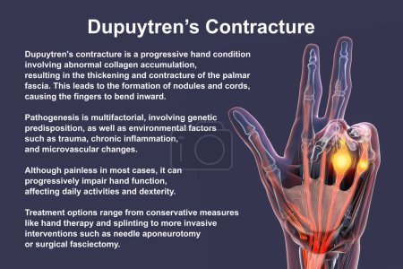 Photo for A 3D medical illustration displaying a patient's hand with Dupuytren's contracture, emphasizing the affected tendons and palmar fascia to illustrate the gross pathology of the condition. - Royalty Free Image