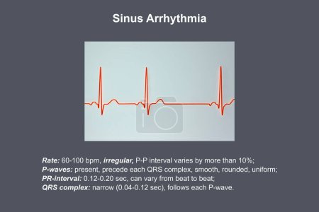 Foto de Una ilustración 3D detallada de un electrocardiograma ECG que muestra arritmia sinusal, una condición caracterizada por ritmos cardíacos irregulares que se originan en el nodo sinusal. - Imagen libre de derechos