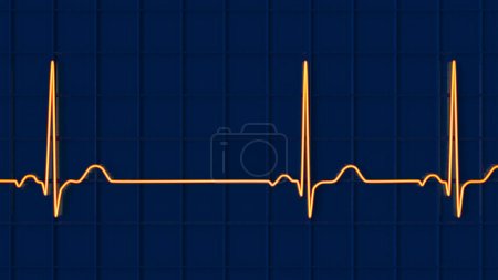 Photo for A detailed 3D illustration of an Electrocardiogram ECG displaying sinus arrhythmia, a condition characterized by irregular heart rhythms originating from the sinus node. - Royalty Free Image