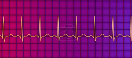 Photo for A detailed 3D illustration of an Electrocardiogram ECG displaying sinus tachycardia, a regular cardiac rhythm with heart rate that is higher than the upper limit of normal of 90-100 bpm in adults. - Royalty Free Image