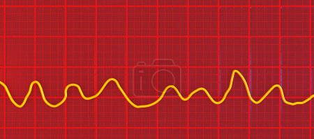 Foto de Una ilustración científica en 3D que representa un electrocardiograma ECG que muestra el ritmo caótico de la fibrilación ventricular, una arritmia cardíaca potencialmente mortal. - Imagen libre de derechos