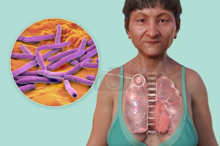 Foto de Una ilustración 3D que muestra la mitad superior de una paciente con piel transparente, revelando los pulmones afectados por la tuberculosis secundaria y una visión cercana de la bacteria Mycobacterium tuberculosis - Imagen libre de derechos