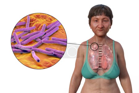 Photo for A 3D illustration showing the upper half part of a female patient with transparent skin, revealing the lungs affected by secondary tuberculosis and close-up view of Mycobacterium tuberculosis bacteria - Royalty Free Image