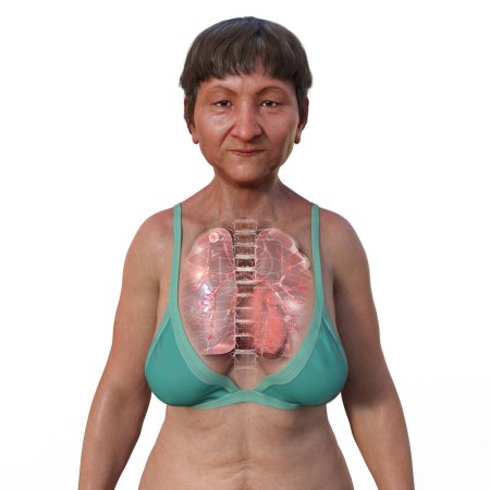 Téléchargez les photos : Illustration 3D montrant la moitié supérieure d'une patiente à peau transparente, révélant les poumons atteints de tuberculose secondaire - en image libre de droit