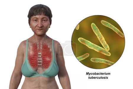 Téléchargez les photos : Illustration photoréaliste 3D de la moitié supérieure d'une femme à peau transparente, montrant les poumons affectés par la tuberculose miliaire et une vue rapprochée de la bactérie Mycobacterium tuberculosis. - en image libre de droit