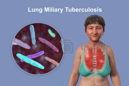 Téléchargez les photos : Illustration photoréaliste 3D de la moitié supérieure d'une femme à peau transparente, montrant les poumons affectés par la tuberculose miliaire et une vue rapprochée de la bactérie Mycobacterium tuberculosis. - en image libre de droit