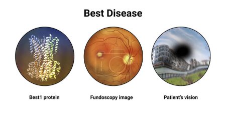 Photo for Best disease. Best vitelliform macular dystrophy, 3D illustration showing Best1 protein, classic fundoscopic egg-yolk lesion on retina, and distorted vision with black spot in a patient - Royalty Free Image